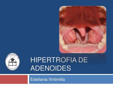 hipertrofia de adenoide-4